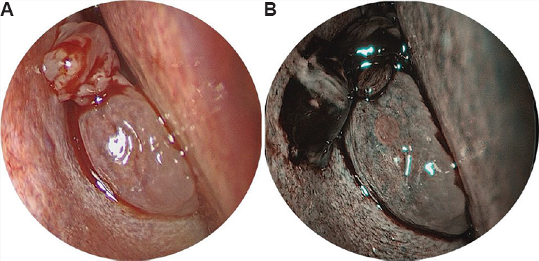 (A) Diagnostic nasal endoscopy revealed a pink fleshy mass which bled to touch, completely filling the right nasal cavity. (B) Narrow band imaging of the nasal mass shows Ni classification type 2 vascular pattern with enlarged, oblique and arborescent vessels and fine white lines of interepithelial papillary capillary loops, which is suggestive of benign lesion.